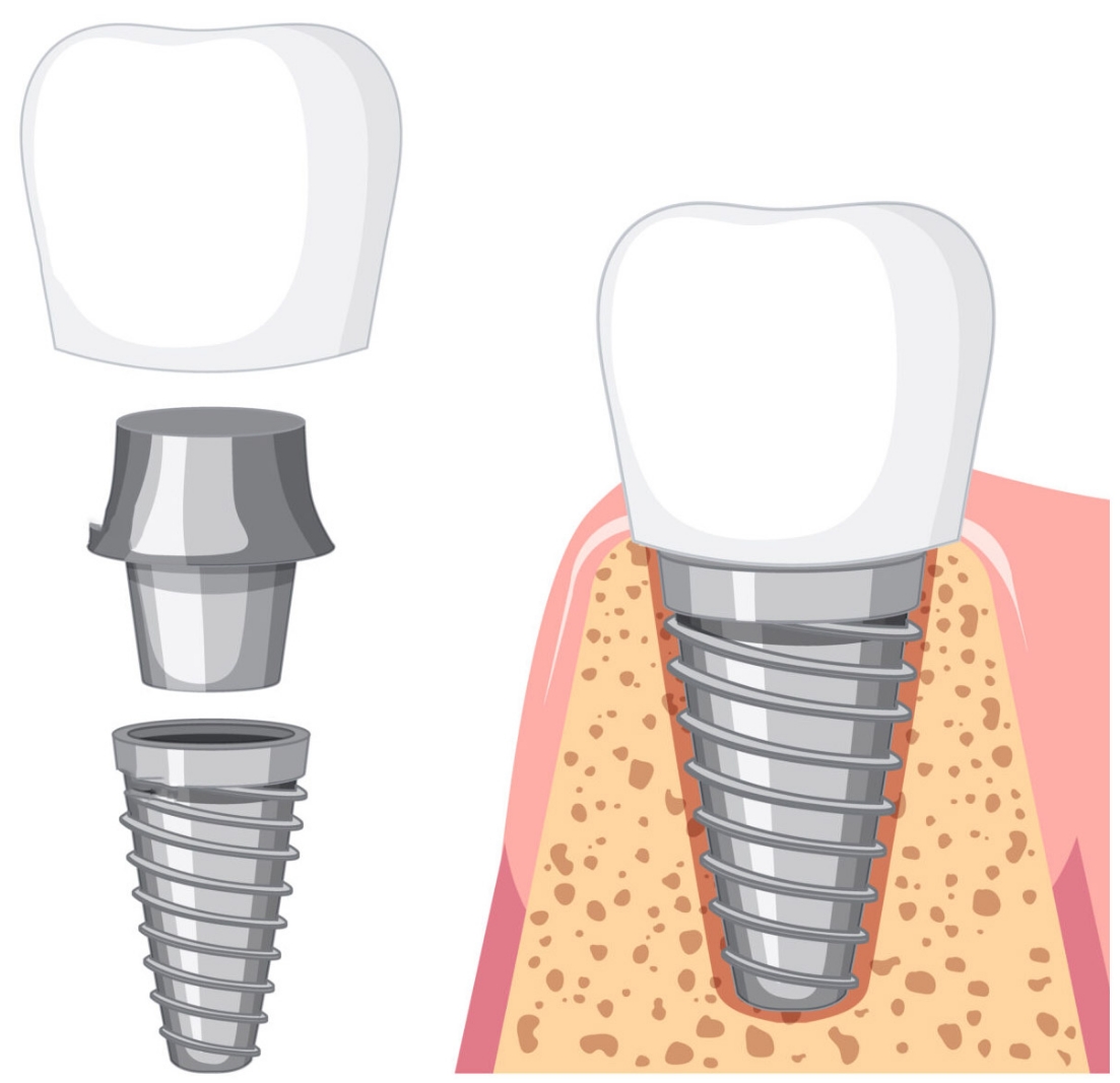 Denti Fissi